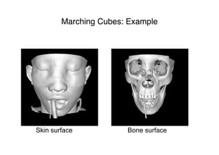 Marching Cubes: Example
Skin surface Bone surface
 