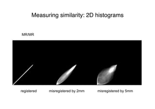 Measuring similarity: 2D histograms
registered misregistered by 2mm misregistered by 5mm
MR/MR
 