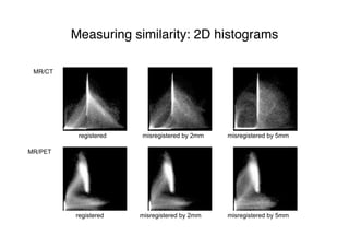 Measuring similarity: 2D histograms
MR/CT
MR/PET
registered misregistered by 2mm misregistered by 5mm
misregistered by 2mm misregistered by 5mmregistered
 