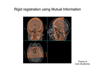 Rigid registration using Mutual Information
Thanks to
Colin Studholme
 