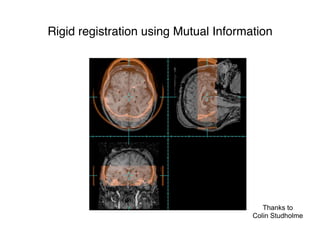 Rigid registration using Mutual Information
Thanks to
Colin Studholme
 
