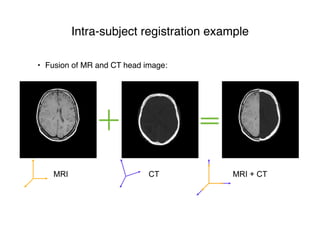 • Fusion of MR and CT head image:
Intra-subject registration example
MRI CT MRI + CT
 