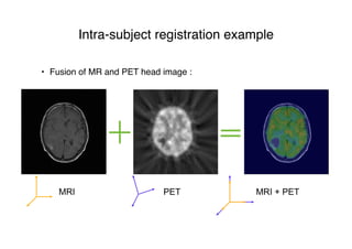 Intra-subject registration example
• Fusion of MR and PET head image :
MRI PET MRI + PET
 