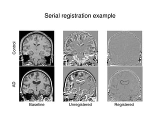 Serial registration exampleControlAD
Baseline Unregistered Registered
 