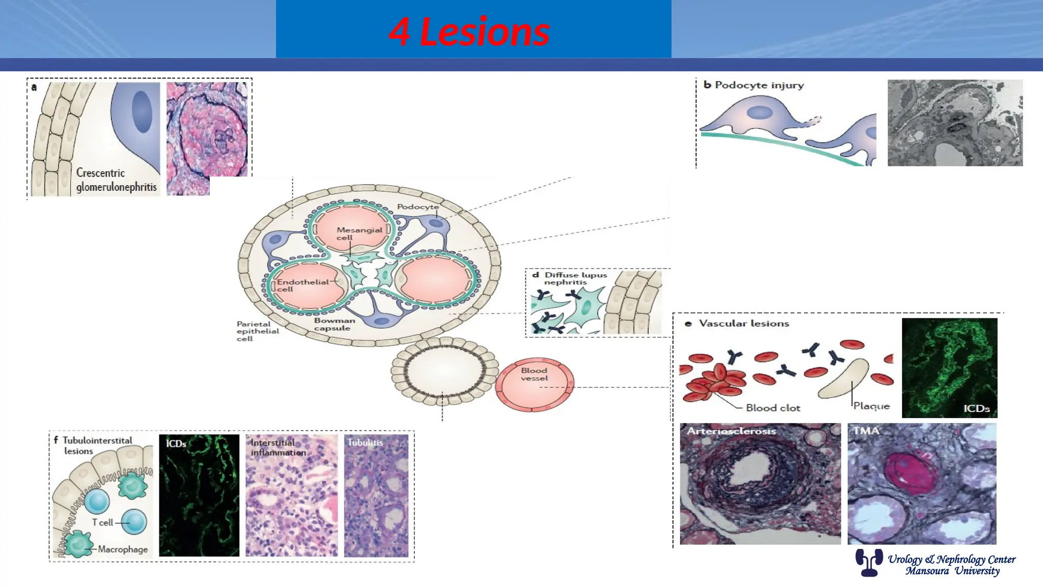 Urology & Nephrology Center
Mansoura University
4 Lesions
 