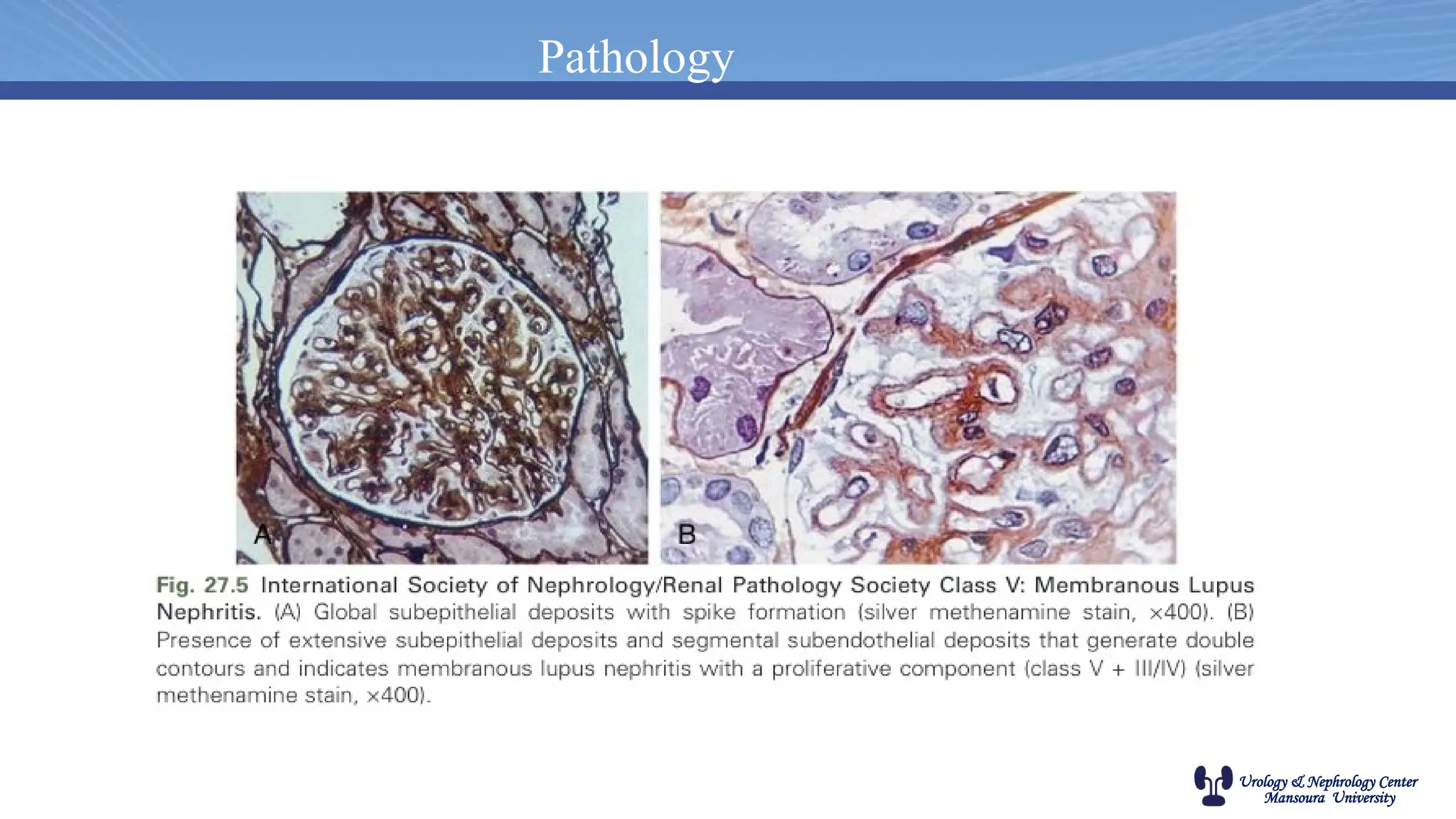Urology & Nephrology Center
Mansoura University
Pathology
 