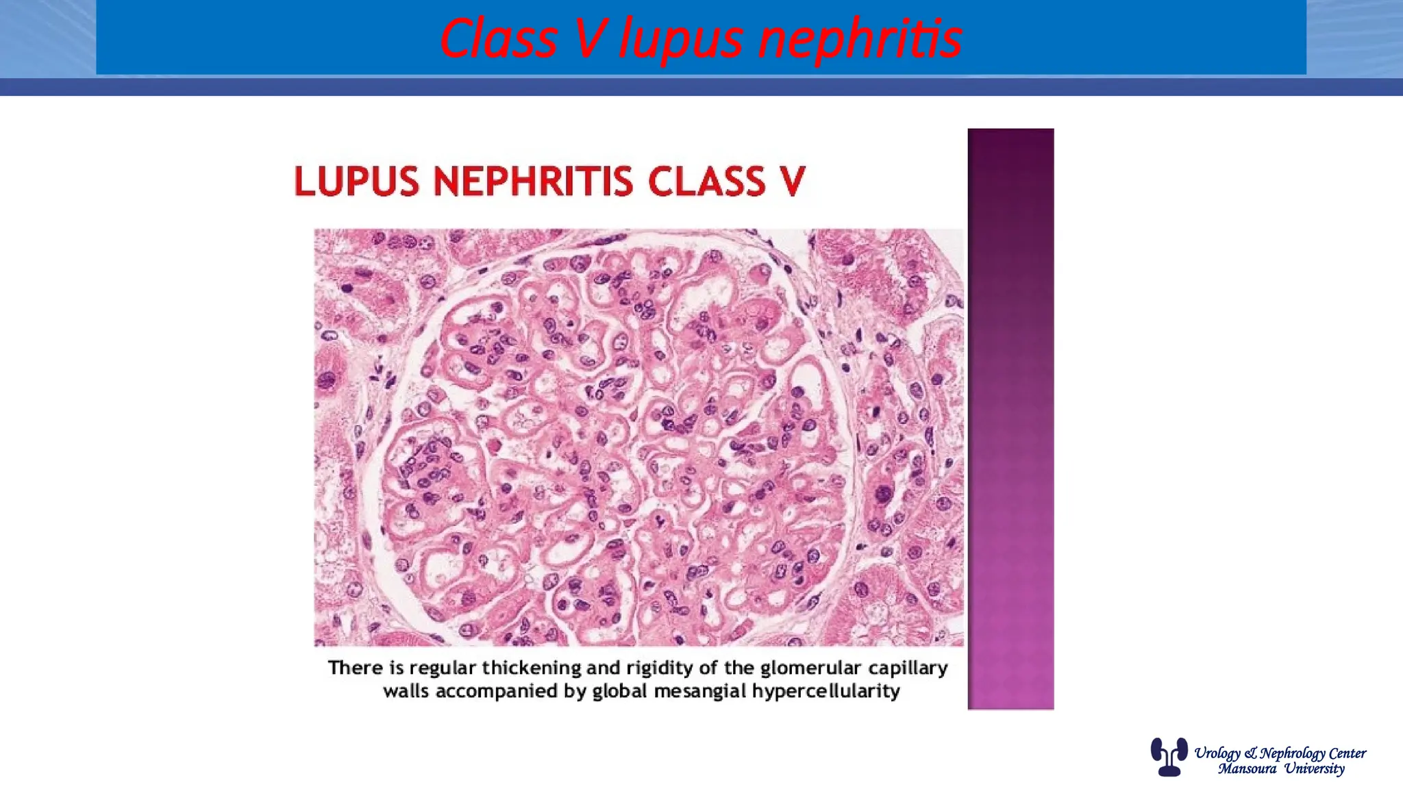 Urology & Nephrology Center
Mansoura University
Class V lupus nephritis
 