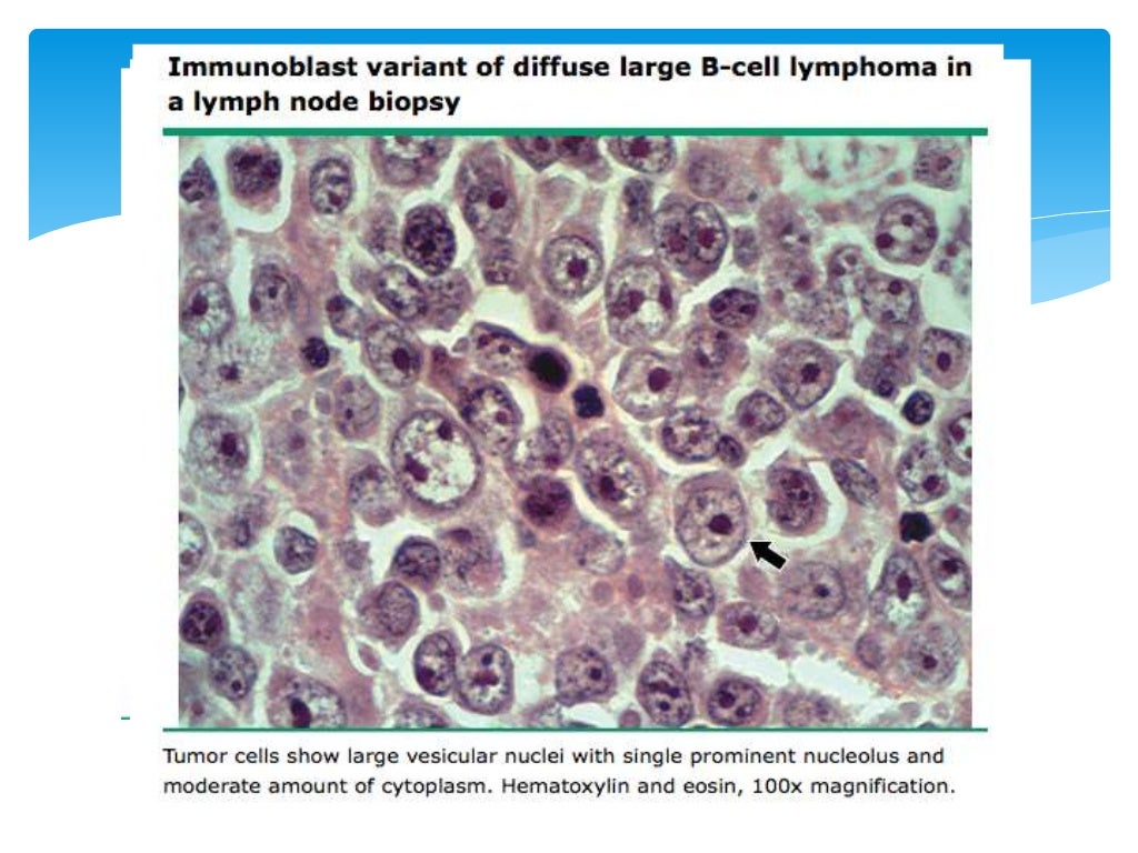 Linfoma No Hodgkin Células Grande B