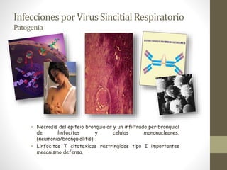 InfeccionesporVirus Sincitial Respiratorio
Patogenia
• Necrosis del epiteio bronquiolar y un infiltrado peribronquial
de linfocitos y celulas mononucleares.
(neumonia/bronquiolitis)
• Linfocitos T citotoxicos restringidos tipo I importantes
mecanismo defensa.
 