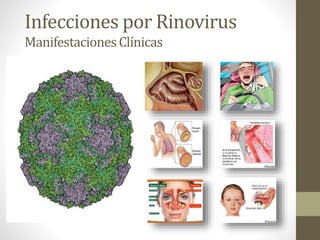 Infecciones por Rinovirus
ManifestacionesClínicas
 