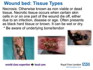 Wound bed: Tissue Types
Necrosis: Otherwise known as non viable or dead
tissue. Necrotic tissue occurs when certain skin
cells in or on one part of the wound die off, either
due to an infection, disease or age. Often presents
as black hard tissue or brown. It can be wet or dry.
* Be aware of underlying bone/tendon
 