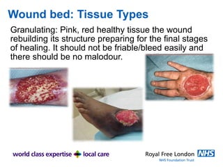 Wound bed: Tissue Types
Granulating: Pink, red healthy tissue the wound
rebuilding its structure preparing for the final stages
of healing. It should not be friable/bleed easily and
there should be no malodour.
 