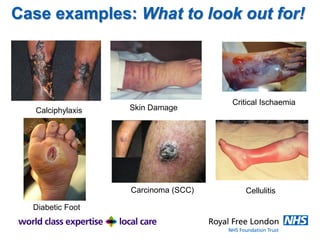 Case examples: What to look out for!
Skin Damage
Critical Ischaemia
CellulitisCarcinoma (SCC)
Calciphylaxis
Diabetic Foot
 