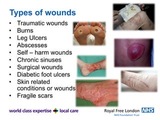 Types of wounds
• Traumatic wounds
• Burns
• Leg Ulcers
• Abscesses
• Self – harm wounds
• Chronic sinuses
• Surgical wounds
• Diabetic foot ulcers
• Skin related
conditions or wounds
• Fragile scars
 