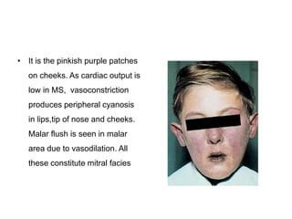 • It is the pinkish purple patches
on cheeks. As cardiac output is
low in MS, vasoconstriction
produces peripheral cyanosis
in lips,tip of nose and cheeks.
Malar flush is seen in malar
area due to vasodilation. All
these constitute mitral facies
 
