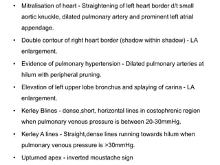 • Mitralisation of heart - Straightening of left heart border d/t small
aortic knuckle, dilated pulmonary artery and prominent left atrial
appendage.
• Double contour of right heart border (shadow within shadow) - LA
enlargement.
• Evidence of pulmonary hypertension - Dilated pulmonary arteries at
hilum with peripheral pruning.
• Elevation of left upper lobe bronchus and splaying of carina - LA
enlargement.
• Kerley Blines - dense,short, horizontal lines in costophrenic region
when pulmonary venous pressure is between 20-30mmHg.
• Kerley A lines - Straight,dense lines running towards hilum when
pulmonary venous pressure is >30mmHg.
• Upturned apex - inverted moustache sign
 