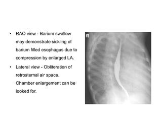 • RAO view - Barium swallow
may demonstrate sickling of
barium filled esophagus due to
compression by enlarged LA.
• Lateral view - Obliteration of
retrosternal air space.
Chamber enlargement can be
looked for.
 