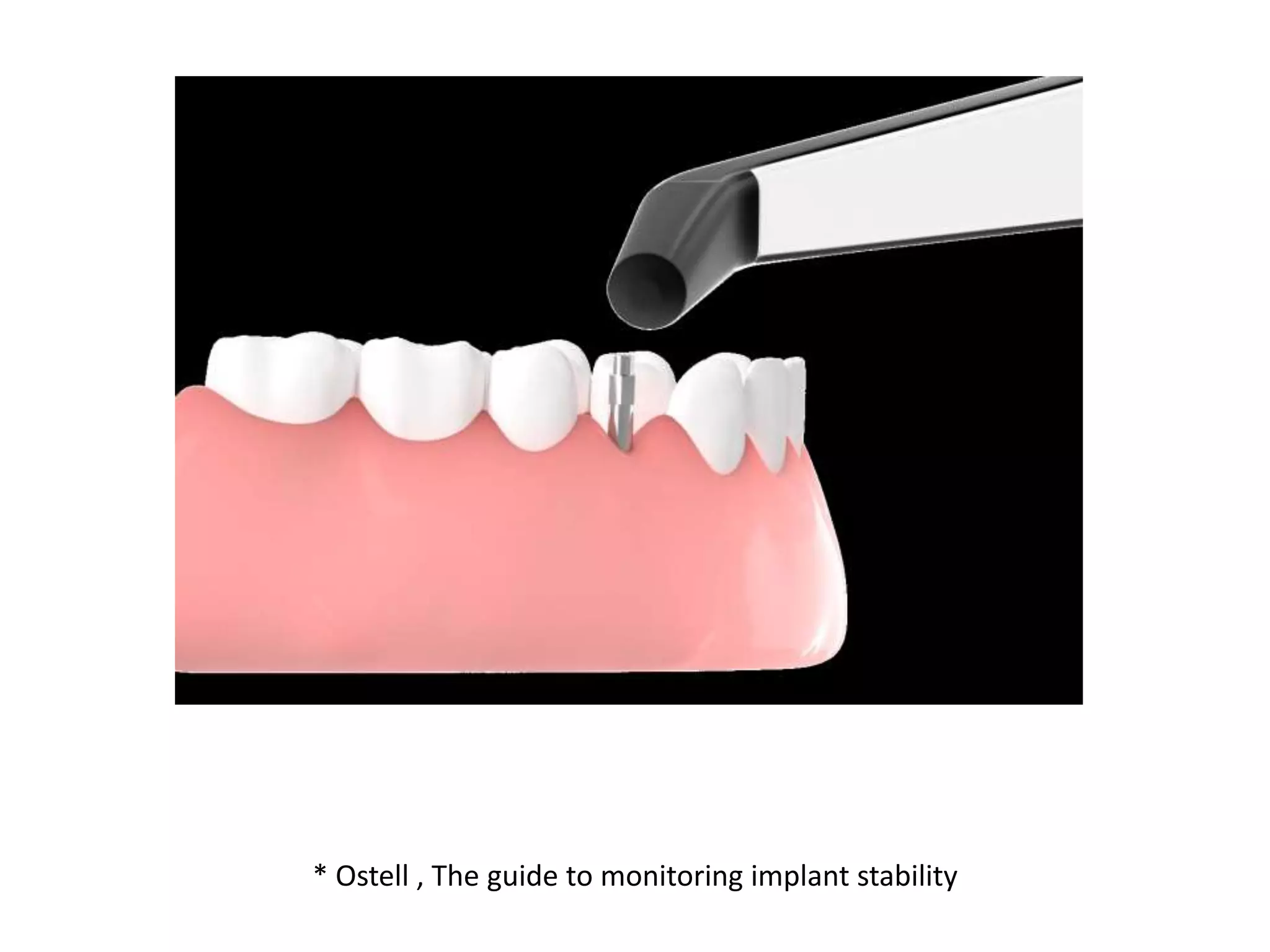 * Ostell , The guide to monitoring implant stability
 