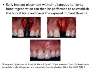 • Early implant placement with simultaneous horizontal
bone regeneration can then be performed to re-establish
the buccal bone and cover the exposed implant threads .
*Bhekare A, Elghannam M, Somji SH, Florio S, Suzuki T. Case Selection Criteria for Predictable
Immediate Implant Placement and Immediate Provisionalization. J Oral Biol. 2018; 5(1): 6
 
