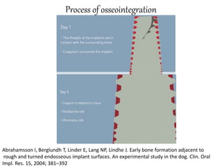 Process of osseointegration
Abrahamsson I, Berglundh T, Linder E, Lang NP, Lindhe J. Early bone formation adjacent to
rough and turned endosseous implant surfaces. An experimental study in the dog. Clin. Oral
Impl. Res. 15, 2004; 381–392
 