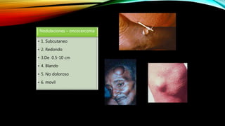Nodulaciones – oncocercoma
• 1. Subcutaneo
• 2. Redondo
• 3.De 0.5-10 cm
• 4. Blando
• 5. No doloroso
• 6. movil
 