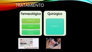 TRATAMIENTO
Farmacológico
Dietilcarbamazina
Suramina
Ivermectina
150mg/kg/1
Quirúrgico
Desnodulizacion
 