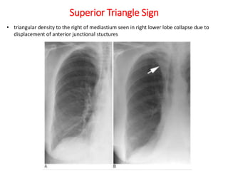 Superior Triangle Sign
• triangular density to the right of mediastium seen in right lower lobe collapse due to
displacement of anterior junctional stuctures
 