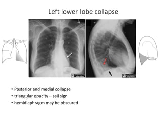 Rml Collapse Radiograph lobar collapse xray.pptx