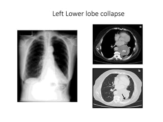 Left Lower lobe collapse
 