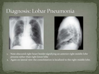 1. Note obscured right heart border signifying an anterior right middle lobe
process rather than right lower lobe
2. Again on lateral view the consolidation is localized to the right middle lobe.
 