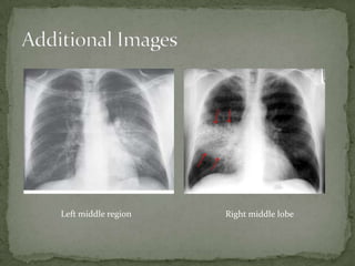 Left middle region Right middle lobe
 