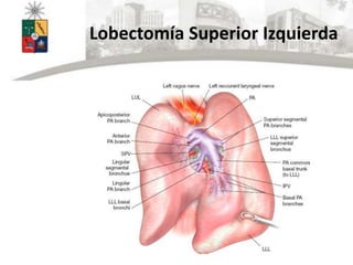 Lobectomía Superior Izquierda
 