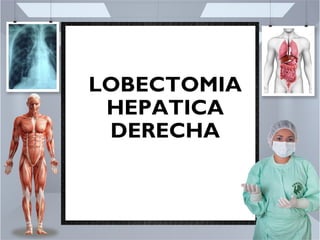 LOBECTOMIA
HEPATICA
DERECHA
 
