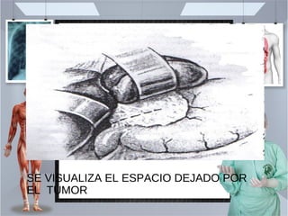 SE VISUALIZA EL ESPACIO DEJADO POR
EL TUMOR
 