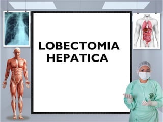 LOBECTOMIA
HEPATICA
 