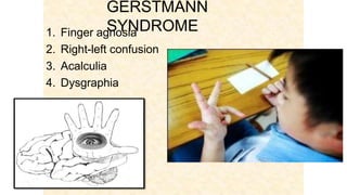 GERSTMANN
SYNDROME1. Finger agnosia
2. Right-left confusion
3. Acalculia
4. Dysgraphia
 
