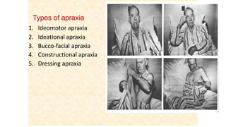 Types of apraxia
1. Ideomotor apraxia
2. Ideational apraxia
3. Bucco-facial apraxia
4. Constructional apraxia
5. Dressing apraxia
 