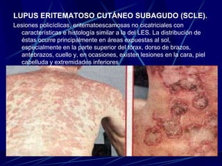 LUPUS ERITEMATOSO CUTÁNEO SUBAGUDO (SCLE).
Lesiones policíclicas, eritematoescamosas no cicatriciales con
características e histología similar a la del LES. La distribución de
éstas ocurre principalmente en áreas expuestas al sol,
especialmente en la parte superior del tórax, dorso de brazos,
antebrazos, cuello y, en ocasiones, existen lesiones en la cara, piel
cabelluda y extremidades inferiores
 