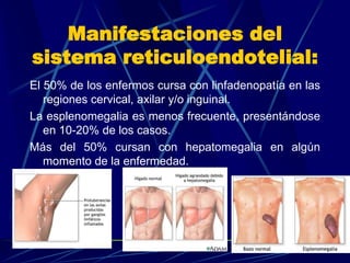 Manifestaciones del
sistema reticuloendotelial:
El 50% de los enfermos cursa con linfadenopatía en las
regiones cervical, axilar y/o inguinal.
La esplenomegalia es menos frecuente, presentándose
en 10-20% de los casos.
Más del 50% cursan con hepatomegalia en algún
momento de la enfermedad.
 