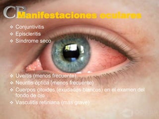Manifestaciones oculares
 Conjuntivitis
 Episcleritis
 Síndrome seco
 Uveítis (menos frecuente)
 Neuritis óptica (menos frecuente)
 Cuerpos citoides (exudados blancos) en el examen del
fondo de ojo
 Vasculitis retiniana (más grave)
 