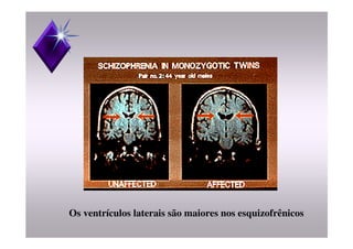 Os ventrículos laterais são maiores nos esquizofrênicos
 