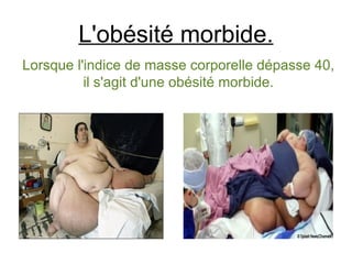 L'obésité morbide.
Lorsque l'indice de masse corporelle dépasse 40,
          il s'agit d'une obésité morbide.
 