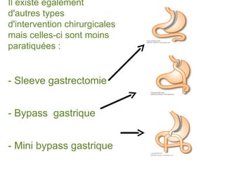 Il existe également
d'autres types
d'intervention chirurgicales
mais celles-ci sont moins
paratiquées :


- Sleeve gastrectomie


- Bypass gastrique


- Mini bypass gastrique
 