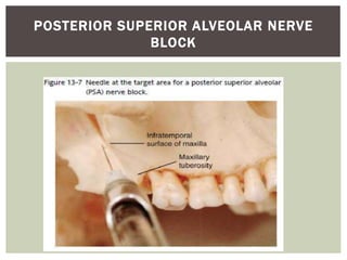 POSTERIOR SUPERIOR ALVEOLAR NERVE
BLOCK
 