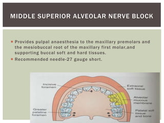  Provides pulpal anaesthesia to the maxillary premolars and
the mesiobuccal root of the maxillary first molar,and
supporting buccal soft and hard tissues.
 Recommended needle-27 gauge short.
MIDDLE SUPERIOR ALVEOLAR NERVE BLOCK
 