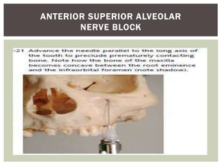 ANTERIOR SUPERIOR ALVEOLAR
NERVE BLOCK
 