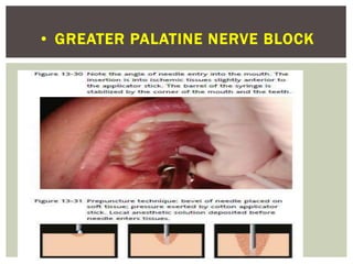 • GREATER PALATINE NERVE BLOCK
 