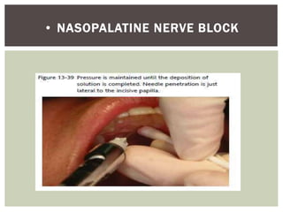 • NASOPALATINE NERVE BLOCK
 