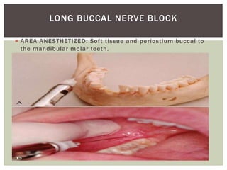  AREA ANESTHETIZED: Soft tissue and periostium buccal to
the mandibular molar teeth.
LONG BUCCAL NERVE BLOCK
 
