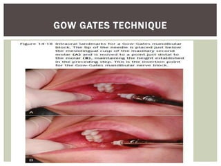 GOW GATES TECHNIQUE
 